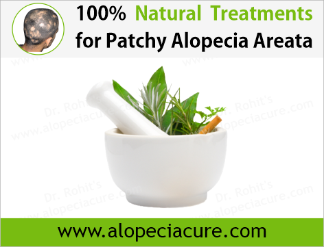 100% Natural Treatments for Alopecia Areata